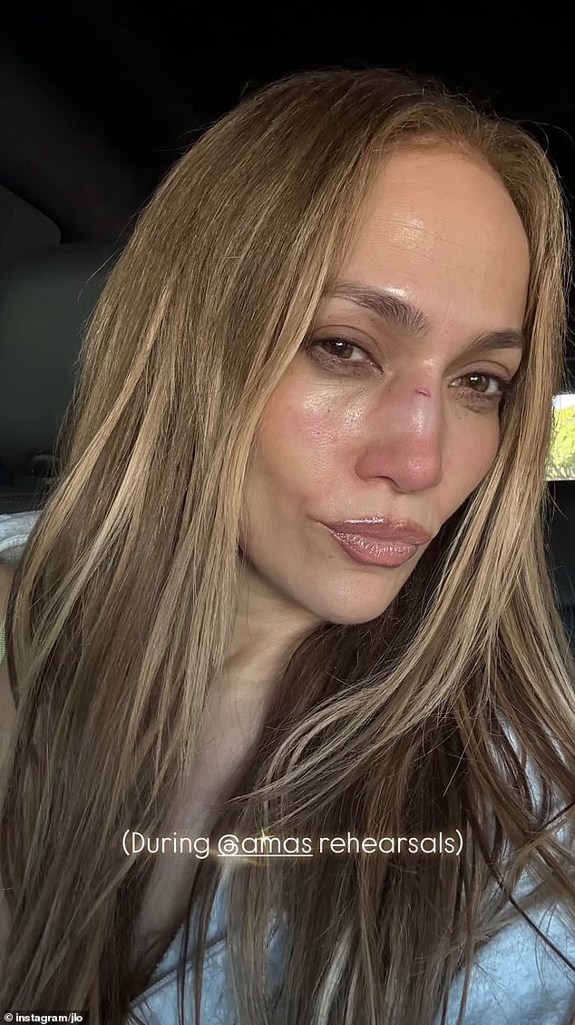 Planet e Jennifer Lopez për të prezantuar American Music Awards pothuajse u shuan pasi ajo pësoi një dëmtim që mund t'i ndryshonte karrierën dhe që kërkoi ndërhyrje të shpejtë nga një kirurg plastik i famshëm.
